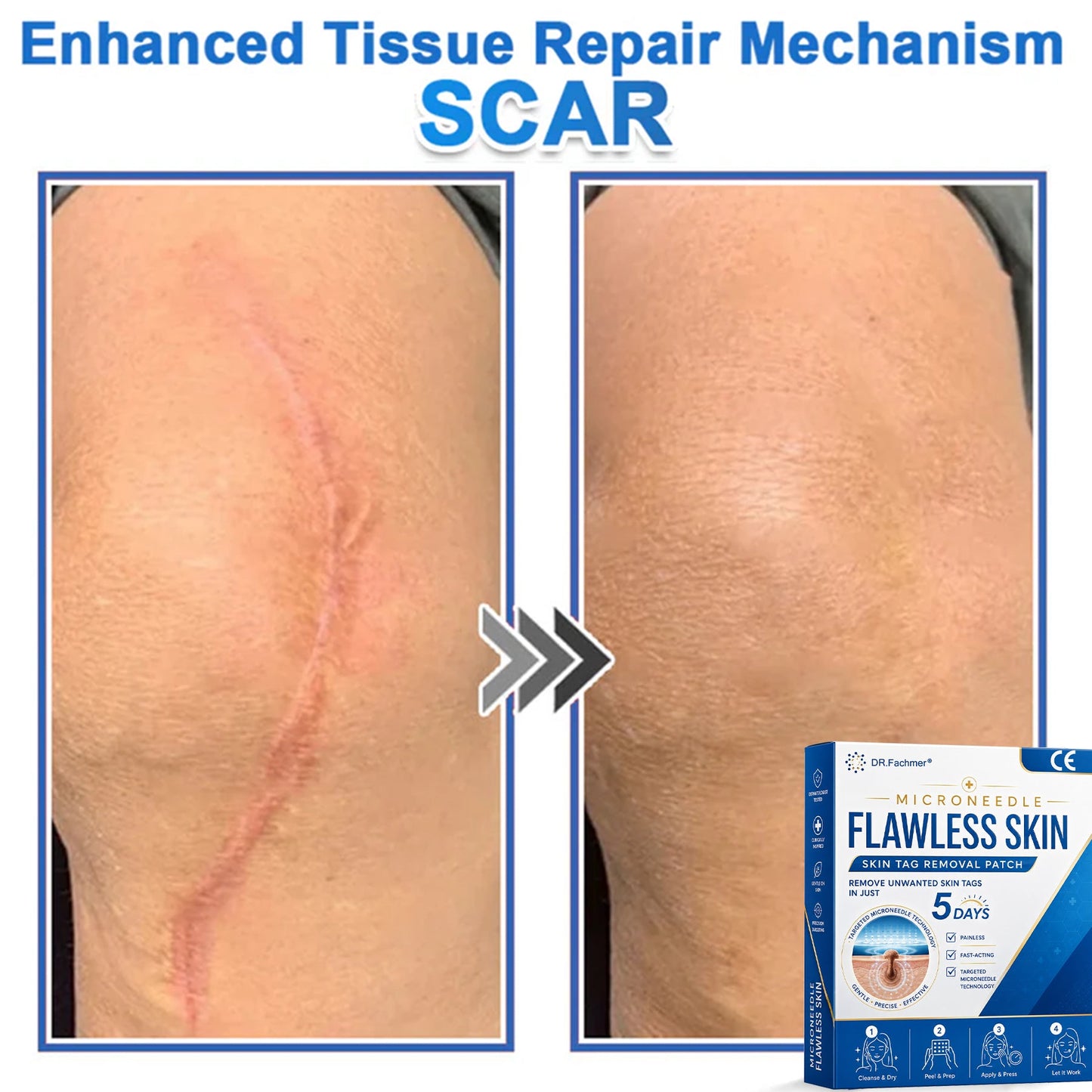 ✅ DR.Fachmer® 2-in-1 Microneedle & Hydrocolloid Patch | Raised Moles,Acne, Flat Warts & Skin Tags Remover | Improves Wrinkles, Scars & Blemishes | Invisible Pimple Patches for Face & Body