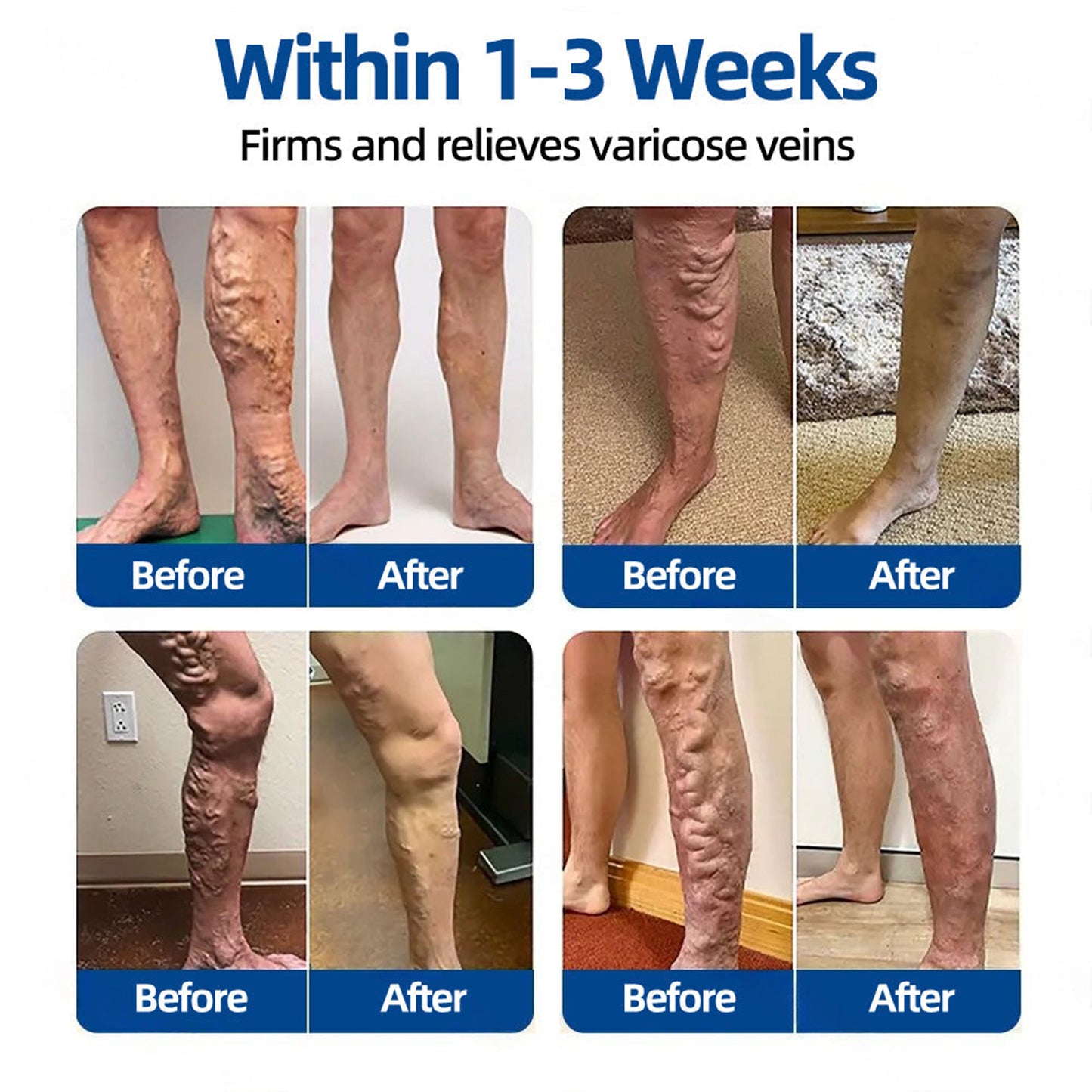 🇦🇺👨‍⚕️丨💗GFOUK® VeinTarget Microneedle Patch⚡Instant Relief, Long-Term Results