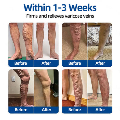🇦🇺👨‍⚕️丨💗GFOUK® VeinTarget Microneedle Patch⚡Instant Relief, Long-Term Results