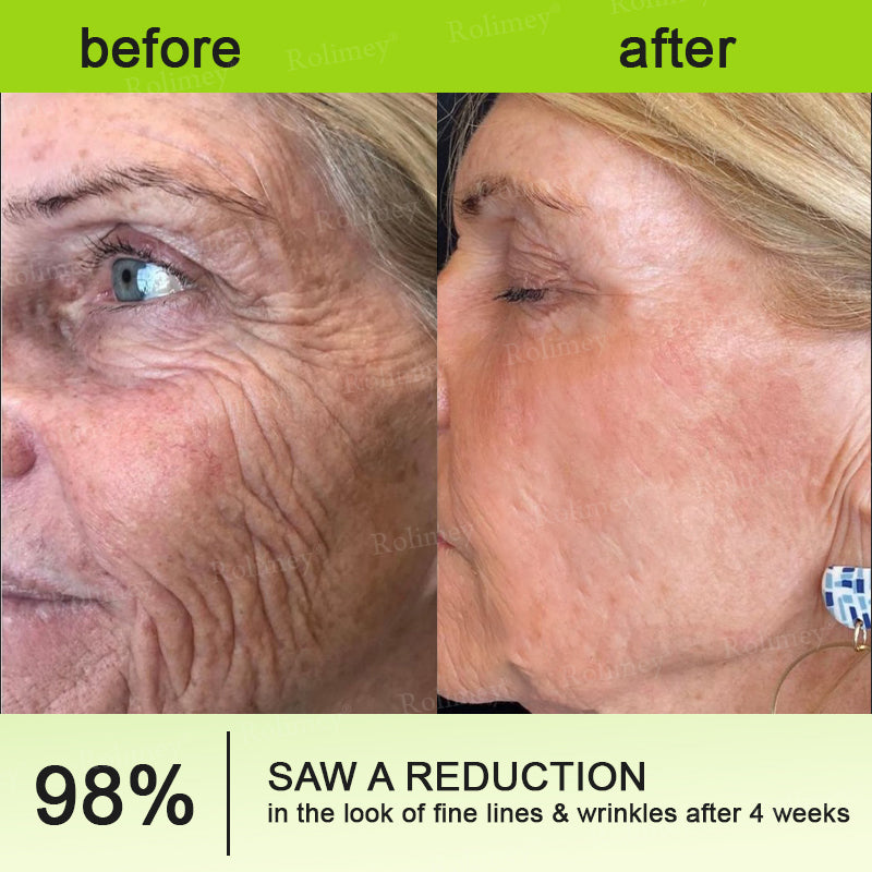 🇦🇺Made and shipped from Australia 🤍Rolimey® Botox & Vita-A Retinol Shot Wrinkle-Lift Tightening cream - Last Day Promotion 70% OFF