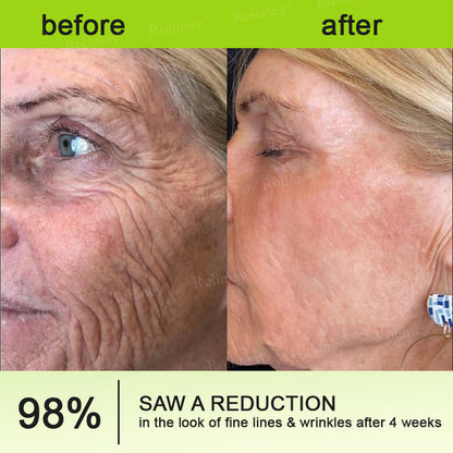 🇦🇺Made and shipped from Australia 🤍Rolimey® Botox & Vita-A Retinol Shot Wrinkle-Lift Tightening cream - Last Day Promotion 70% OFF