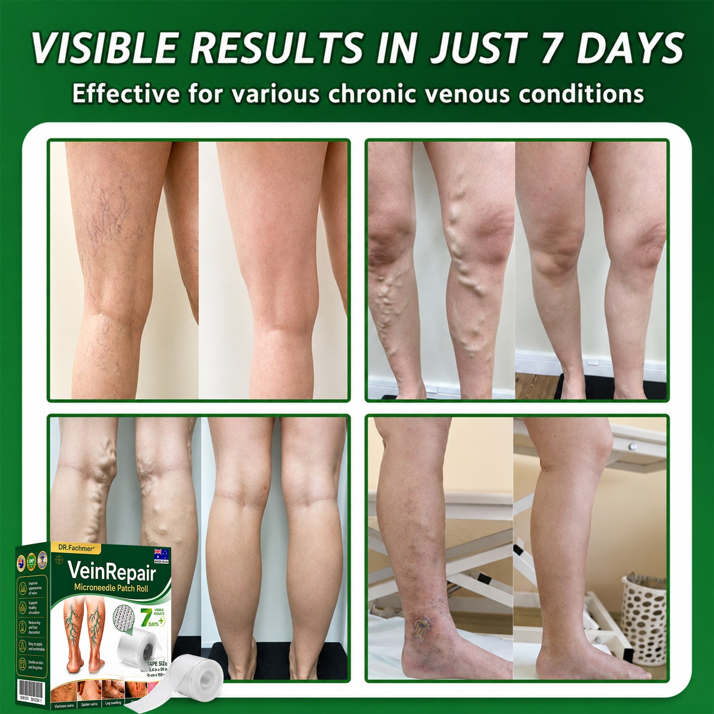 🇦🇺🩵✅DR.Fachmer® Vein Ease Microneedle Care Patch(For Spider Veins, Varicose Veins, Swelling & Leg Fatigue) - Last Day Promotion 50% OFF