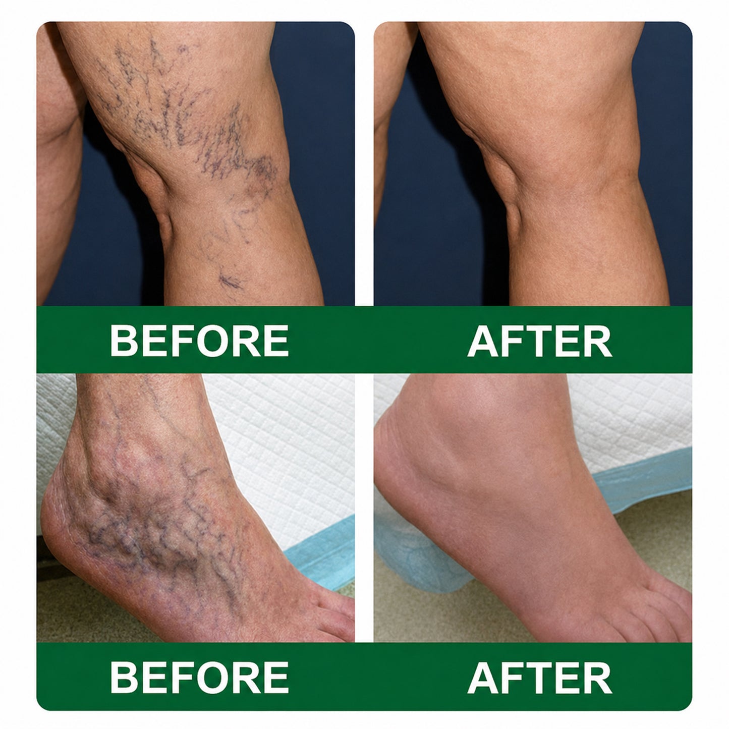 🇦🇺🩵✅DR.Fachmer® Vein Ease Microneedle Care Patch(For Spider Veins, Varicose Veins, Swelling & Leg Fatigue) - Last Day Promotion 50% OFF