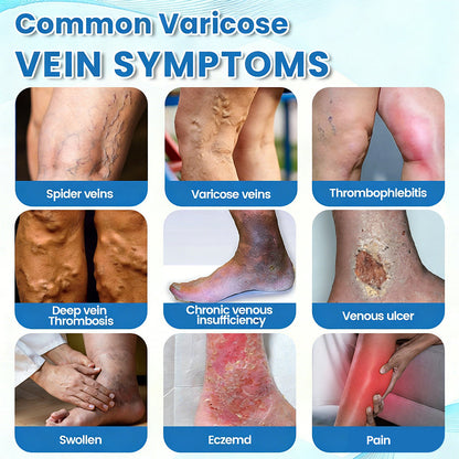 🇦🇺⌛✅🌿𝙂𝙁𝙊𝙐𝙆® VEINRX Healing Spray (Designed for Varicose veins, Spider veins, Deep vein Thrombosis, Chronic venous insufficiency, Venous ulcers, Thrombophlebitis and other venous issues)