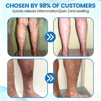🇦🇺⌛✅🌿𝙂𝙁𝙊𝙐𝙆® VEINRX Healing Spray (Designed for Varicose veins, Spider veins, Deep vein Thrombosis, Chronic venous insufficiency, Venous ulcers, Thrombophlebitis and other venous issues)