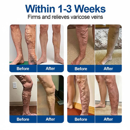 🇦🇺🩹✅GFOUK® VeinTarget Microneedle Patch⚡Instant Relief, Long-Term Results