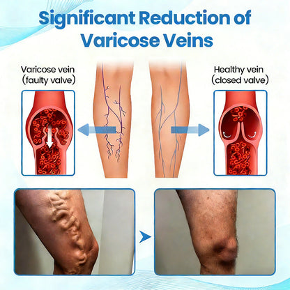 🇦🇺⌛✅🌿𝙂𝙁𝙊𝙐𝙆® VEINRX Healing Spray (Designed for Varicose veins, Spider veins, Deep vein Thrombosis, Chronic venous insufficiency, Venous ulcers, Thrombophlebitis and other venous issues)