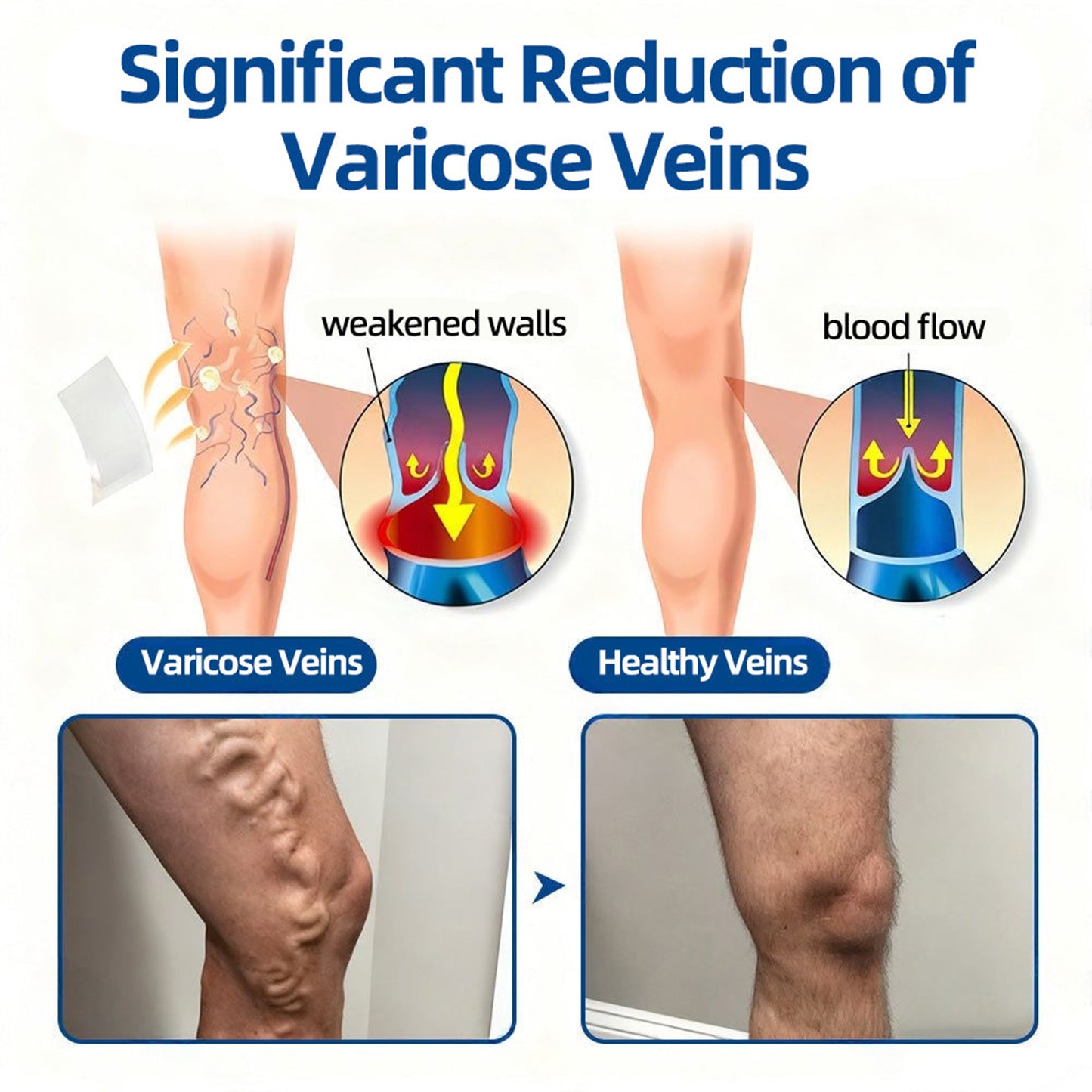 🇦🇺👨‍⚕️丨💗GFOUK® VeinTarget Microneedle Patch⚡Instant Relief, Long-Term Results