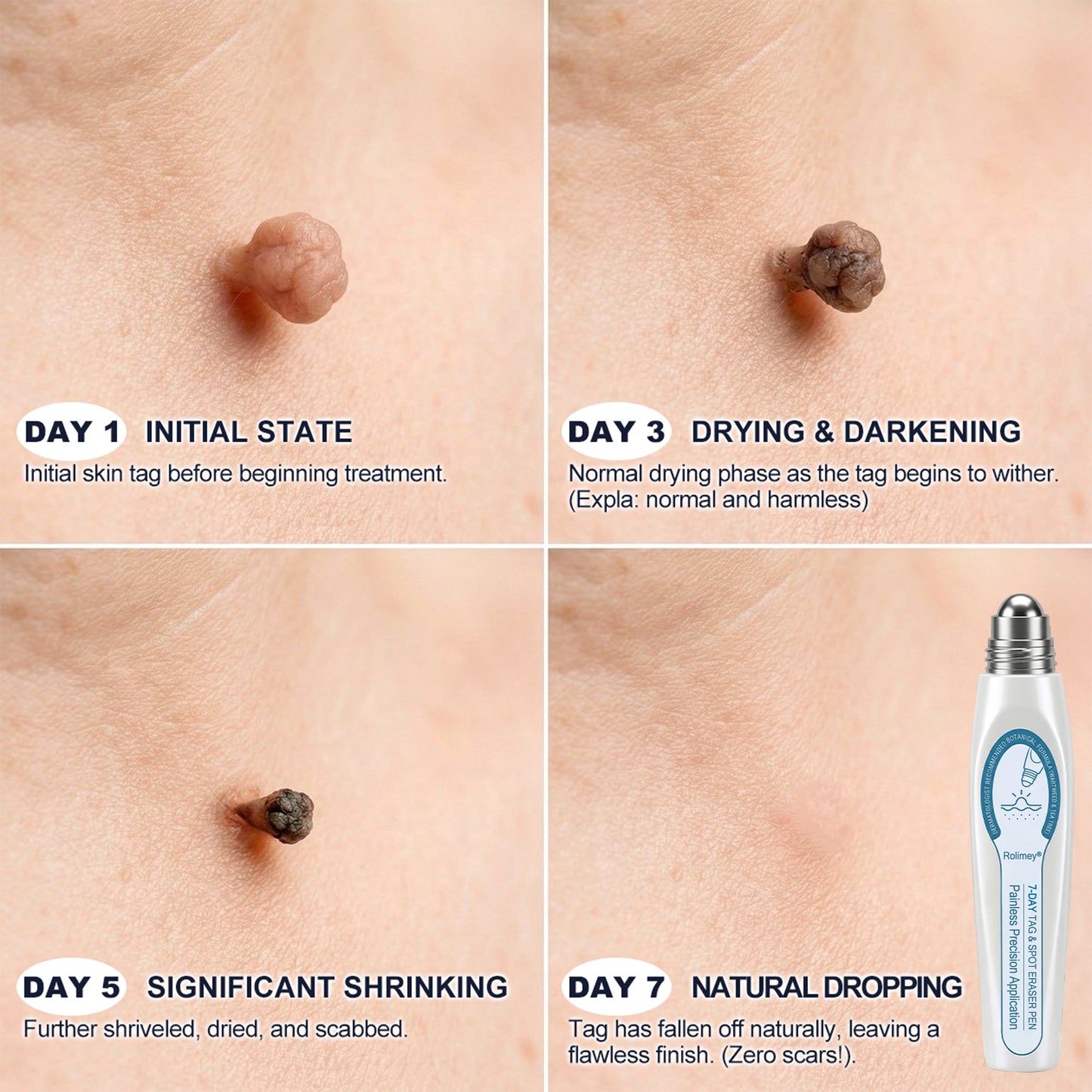 🍇Rolimey® 7-Day Roll-On for Skin Spots and Skin Tags – Pain-Free & Scar-Free