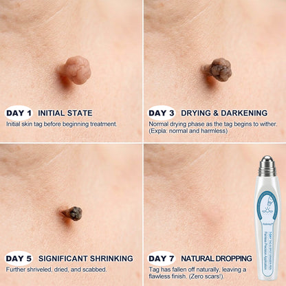 🍇Rolimey® 7-Day Roll-On for Skin Spots and Skin Tags – Pain-Free & Scar-Free