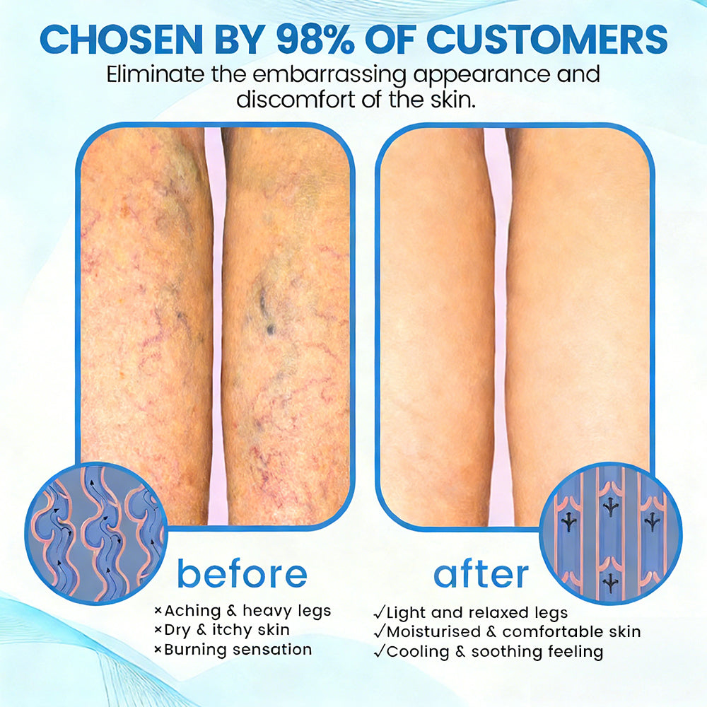 🇦🇺⌛✅🌿𝙂𝙁𝙊𝙐𝙆® VEINRX Healing Spray (Designed for Varicose veins, Spider veins, Deep vein Thrombosis, Chronic venous insufficiency, Venous ulcers, Thrombophlebitis and other venous issues)
