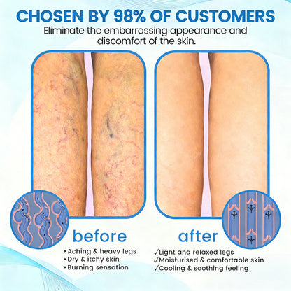 🇦🇺⌛✅🌿𝙂𝙁𝙊𝙐𝙆® VEINRX Healing Spray (Designed for Varicose veins, Spider veins, Deep vein Thrombosis, Chronic venous insufficiency, Venous ulcers, Thrombophlebitis and other venous issues)