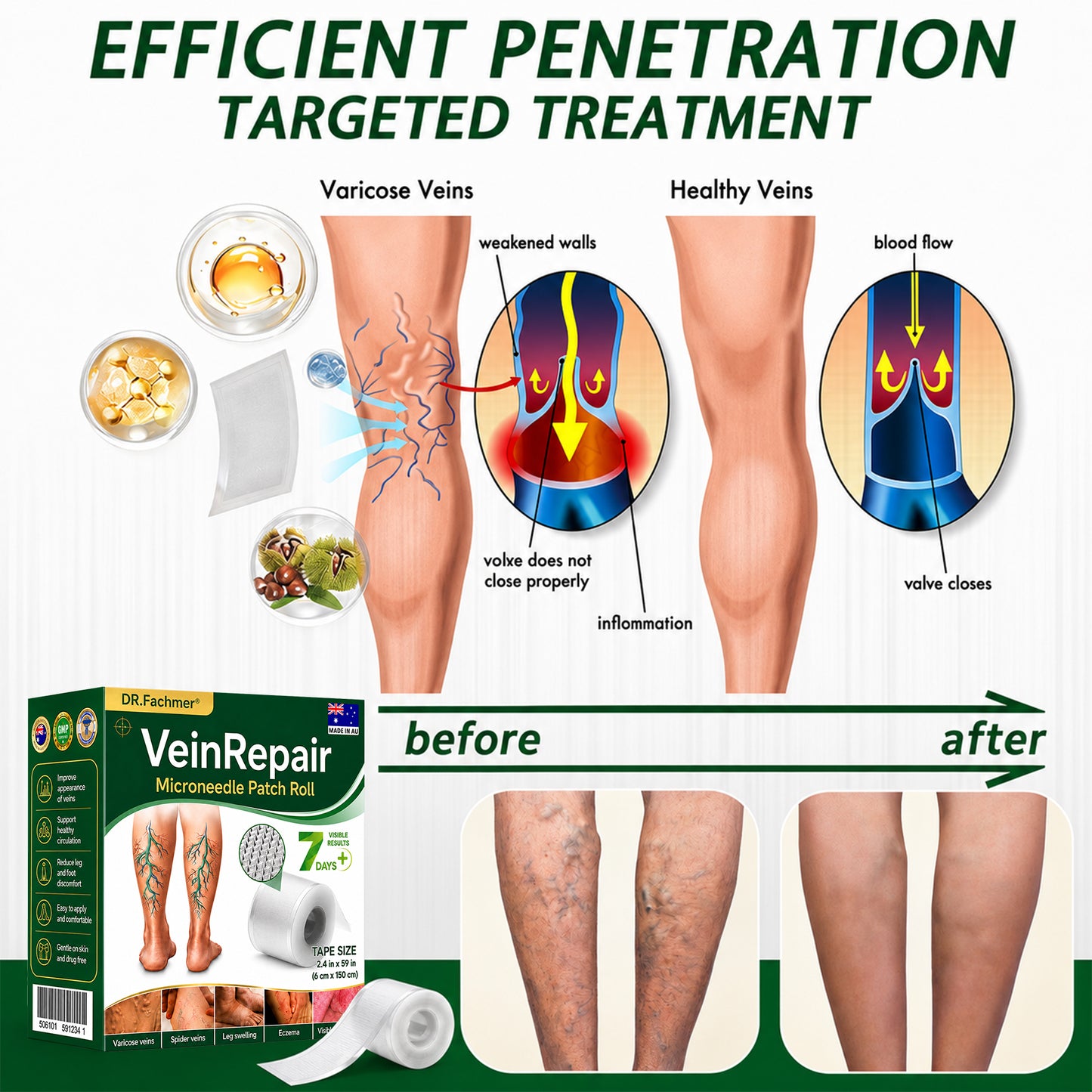 🇦🇺🩵✅DR.Fachmer® Vein Ease Microneedle Care Patch(For Spider Veins, Varicose Veins, Swelling & Leg Fatigue) - Last Day Promotion 50% OFF
